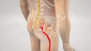 Pittsburgh Sciatica Lawyer